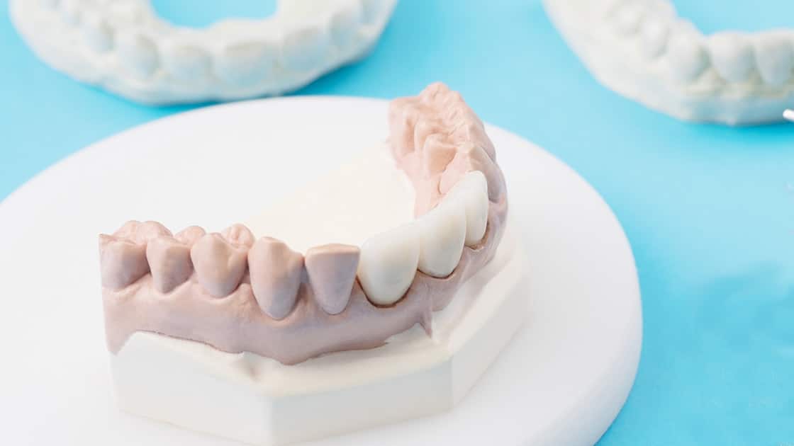 Dental Bridge image