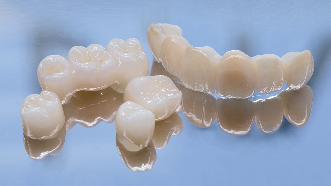 Dental Crowns