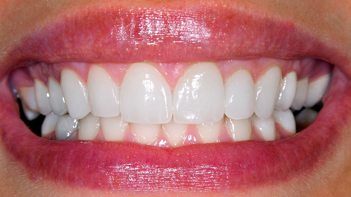 Dental veneers