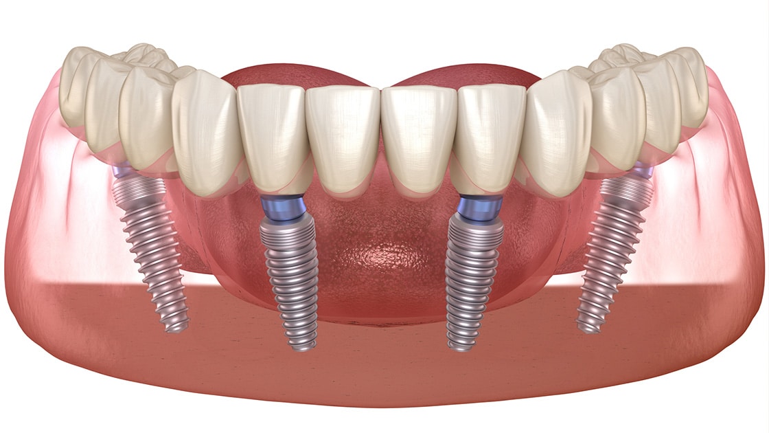 Full Arch Implant